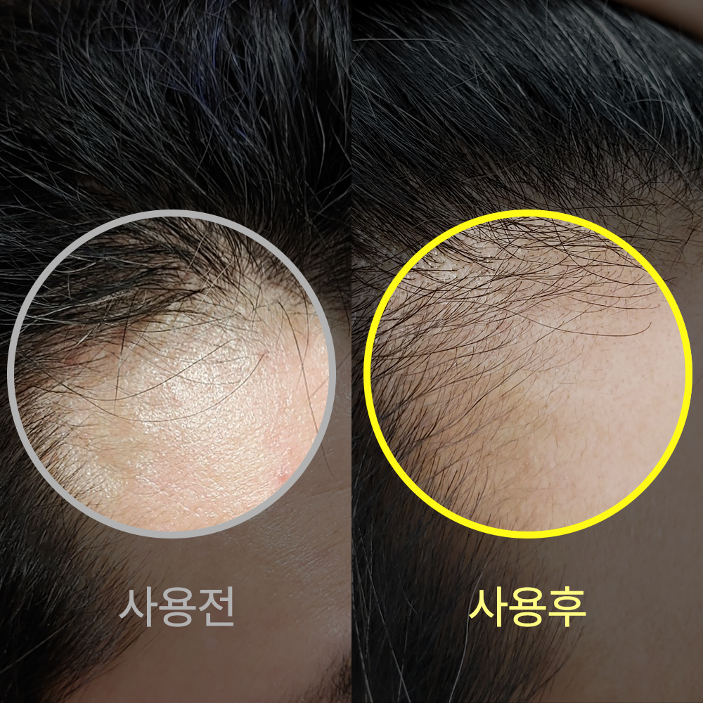 발모레아3.3 LNP 두피 세럼 10ml 1개_4