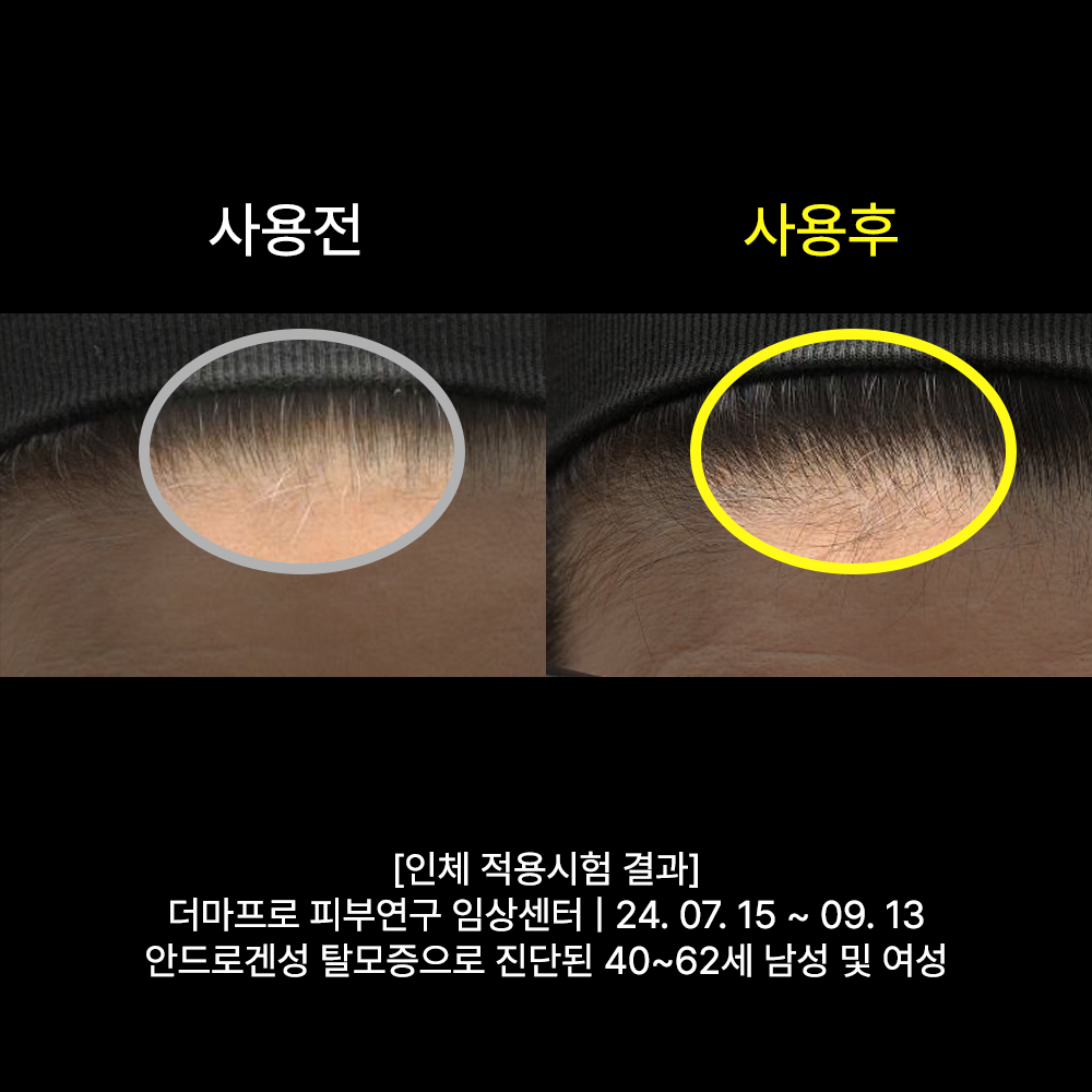 발모레아3.3 LNP 두피 세럼 10ml 1개_6